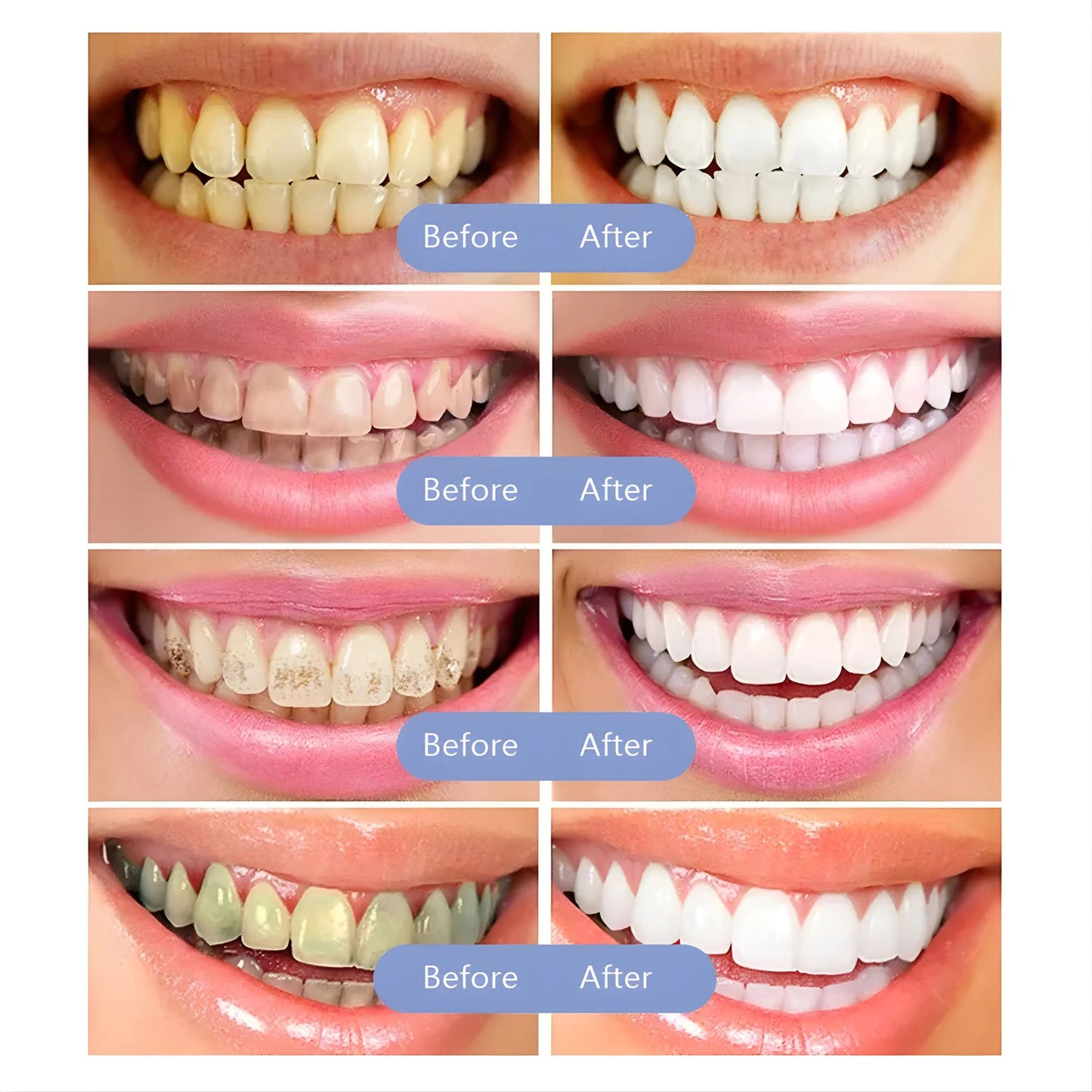 Resultados blanqueamiento dental antes y después con BrightLite
